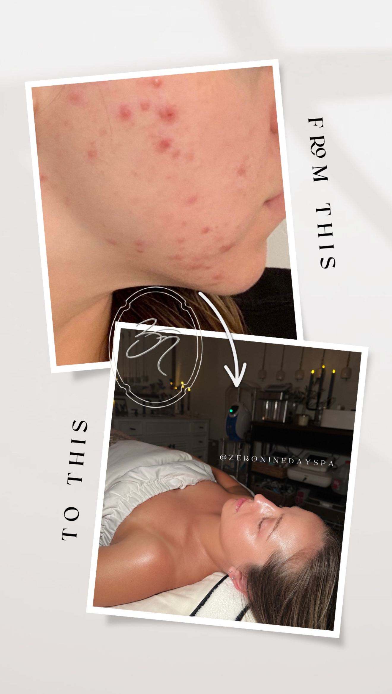 Promotional post for Zero Nine Day Spa highlighting acne treatments, featuring a call-to-action to book an appointment for clear skin and emphasizing being the best spa for acne in Scottsdale. Includes a playful, relatable tone with a touch of humor and a sparkling emphasis on glowing skin goals.