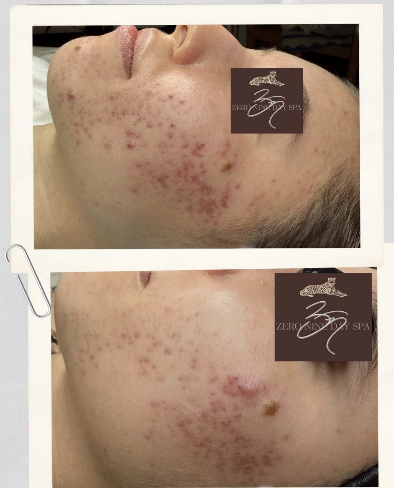 Before and after TCA CROSS treatment for acne scars showing improvement in ice pick and boxcar scars after one session with reduced redness and smoother skin texture